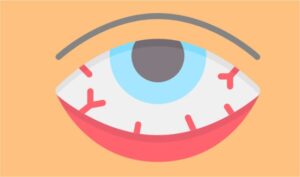 Bindehautentzündung bei Kindern: Ursachen & Symptome